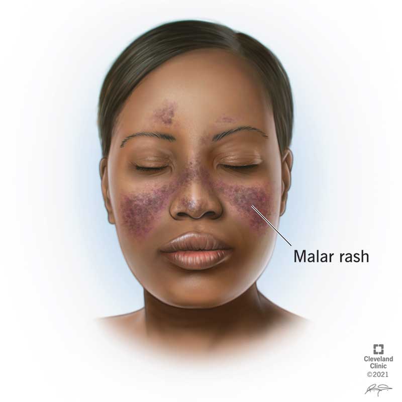 Lupus Rash: Types, Causes, Treatment & Prevention