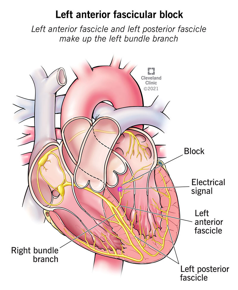 Illustration of left anterior fascicular block making the left ventricle contract late.