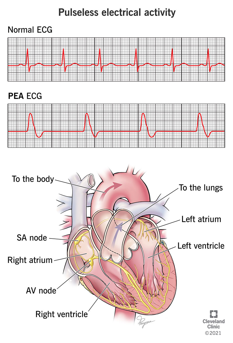 EKG illustrating pulseless electrical activity (PEA)
