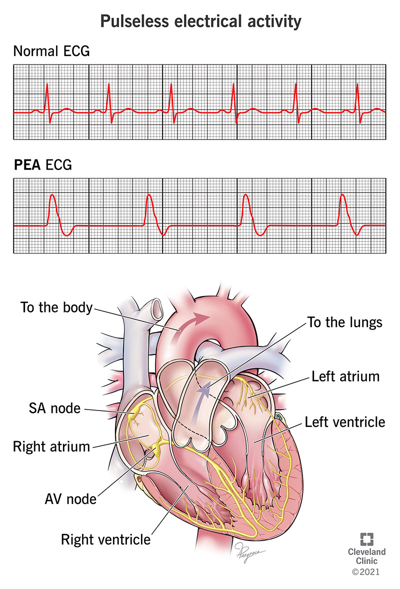 pulseless electrical activity vs asystole