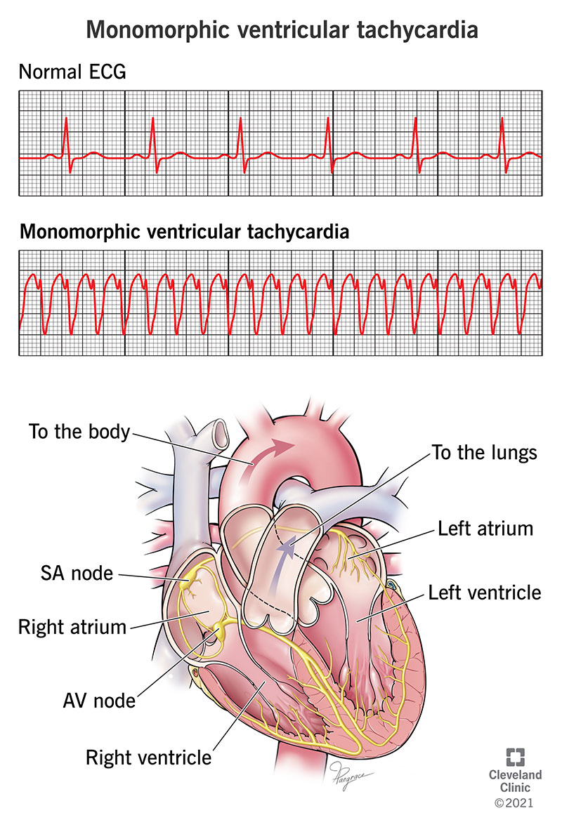 An EKG showing monomorphic ventricular tachycardia.