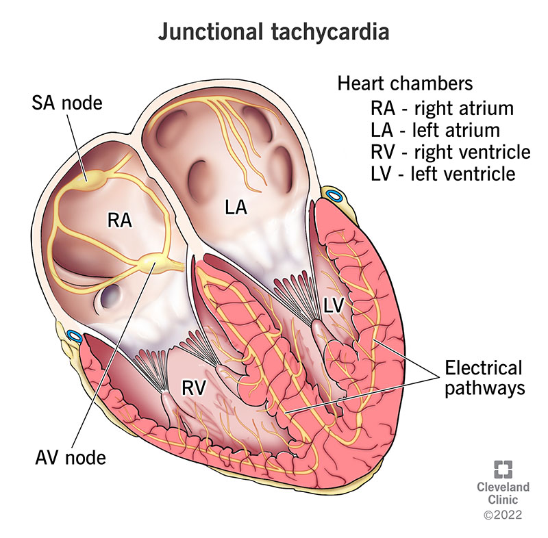 Junctional tachycardia is a fast heart rhythm that starts in the wrong place in your heart.