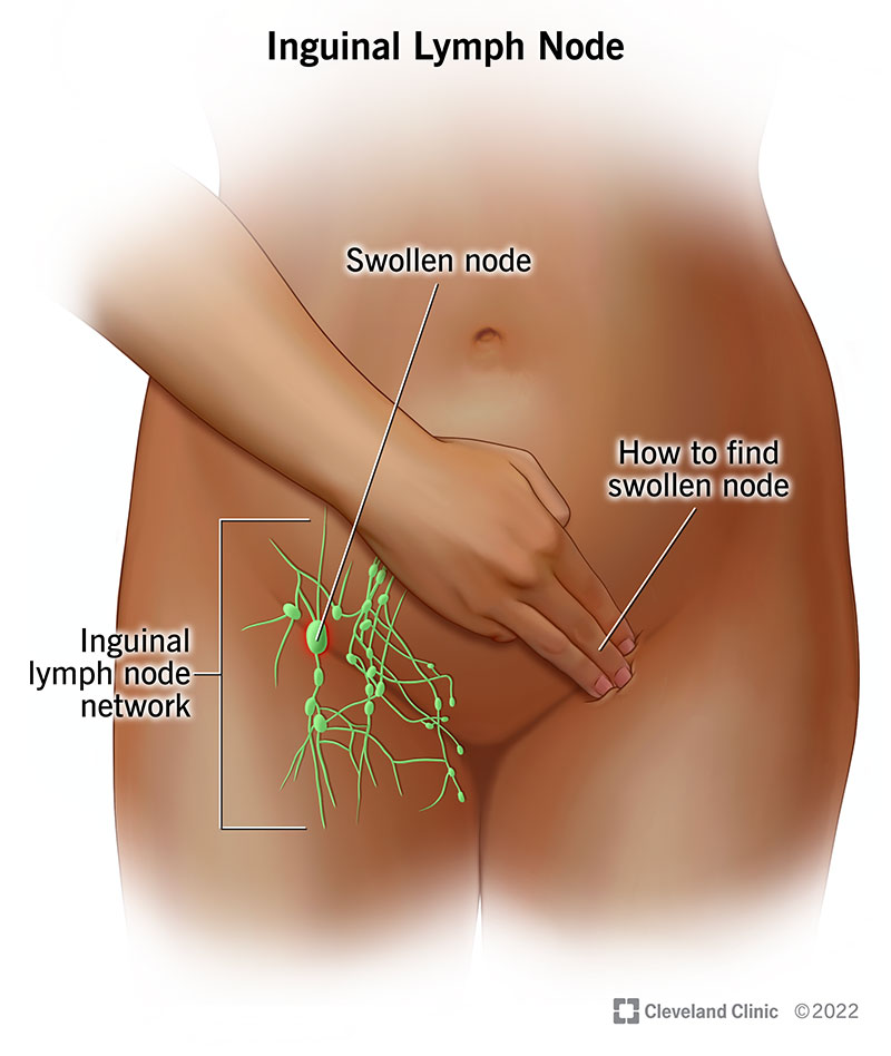Inguinal lymph nodes can be hard to feel unless they’re swollen.