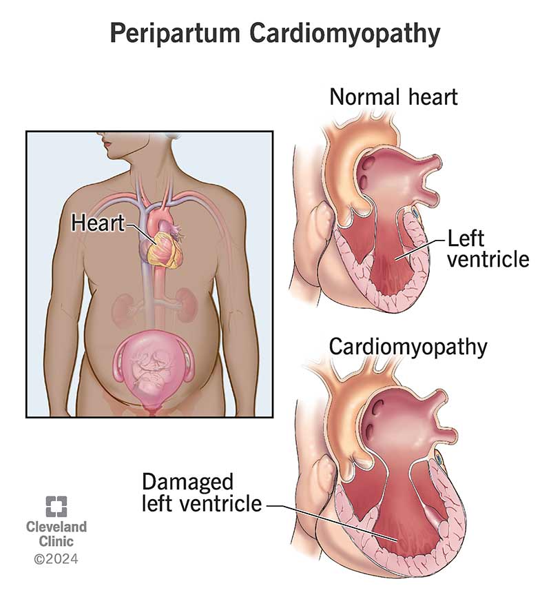 Unlike a normal heart, one with peripartum cardiomyopathy has damage in a chamber that pumps blood to your body.