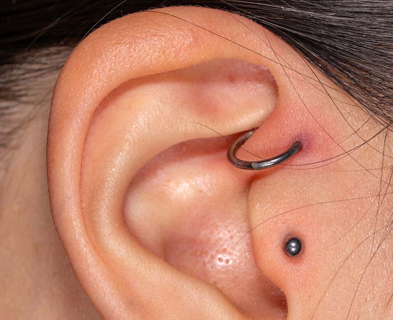 Perichondritis is an infection of the tissue lining the cartilage of your outer ear. It usually only affects the upper part of your ear, not your earlobe. It causes pain, swelling and redness.