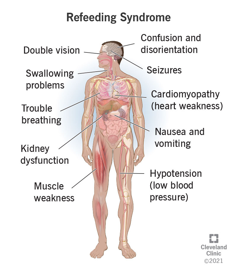 Symptoms of refeeding syndrome occur throughout the body.