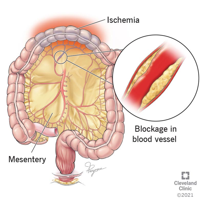 Narrowed and blocked arteries in the mesentery can cause ischemia, depriving your digestive tract of vital blood and oxygen.