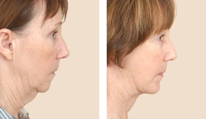 A person before and after a chin implant surgery.