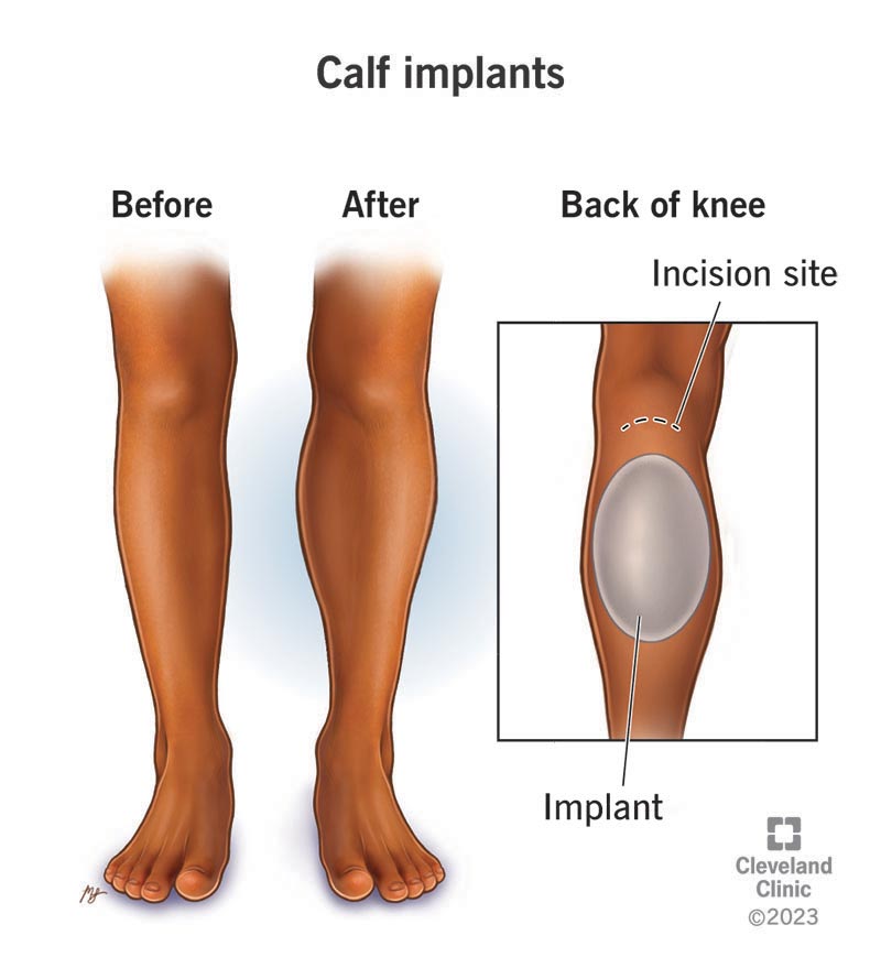 Before and after calf implants, showing location of incision.