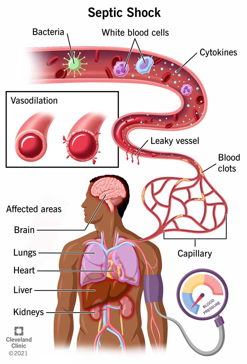 Septic shock occurs when a bacterial infection causes low blood pressure, widening of the blood vessels (vasodilation) and organ failure.