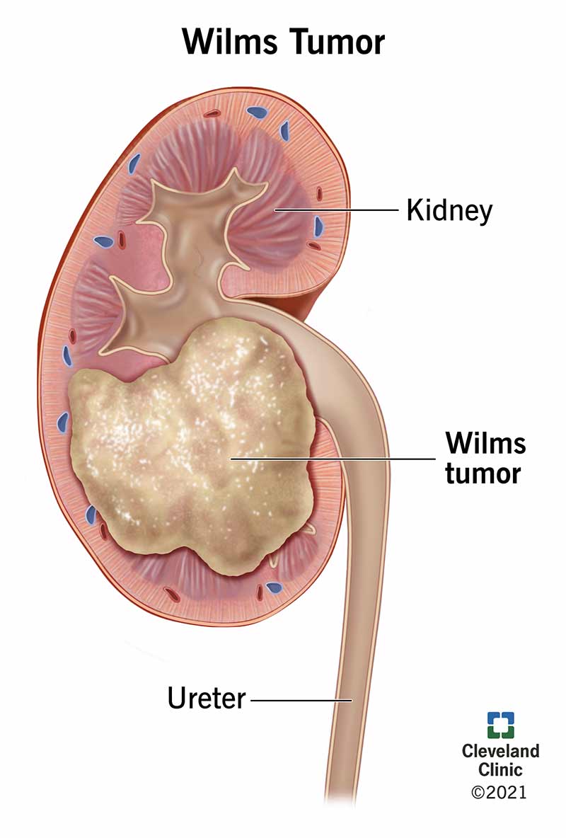A Wilms tumor is growing on a kidney near the ureter.