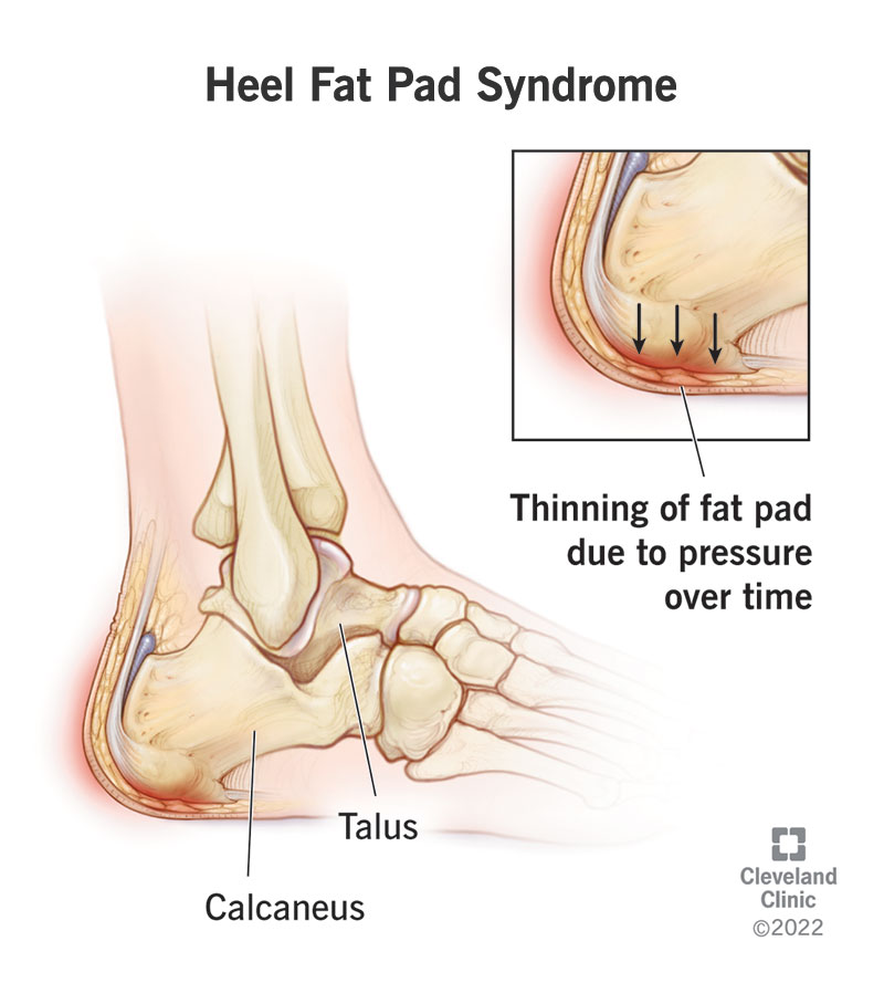 Illustration of heel fat pad syndrome.