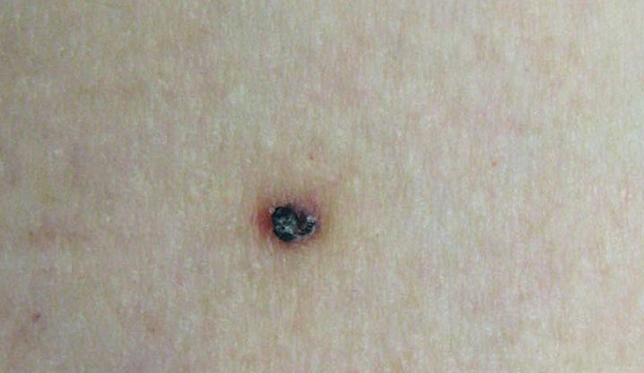 A purplish-black angiokeratoma with a reddish border.