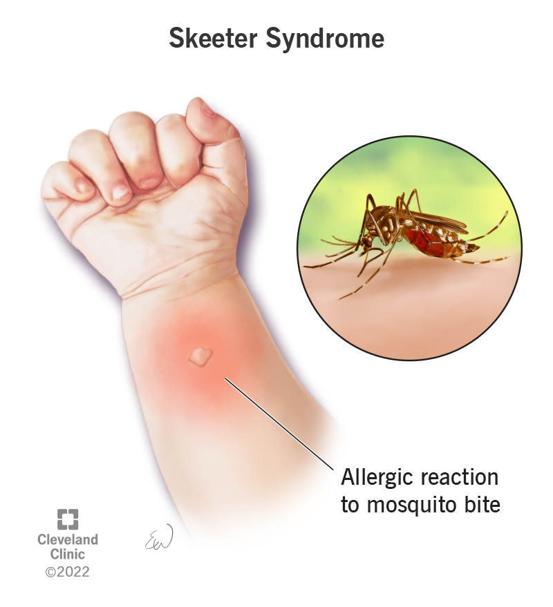 Skeeter syndrome, an allergic reaction to the saliva of the mosquito that bites you, creates a lump surrounded by swelling.