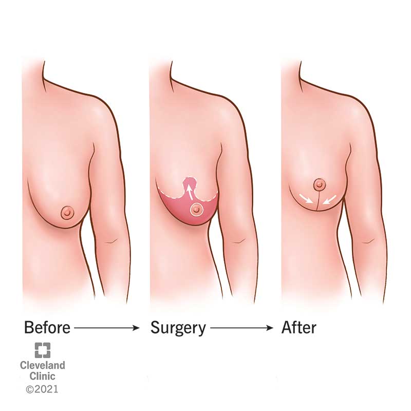 Female chest before, during and after breast lift.