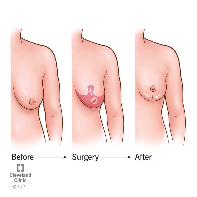 https://my.clevelandclinic.org/-/scassets/images/org/health/articles/23298-breast-lift