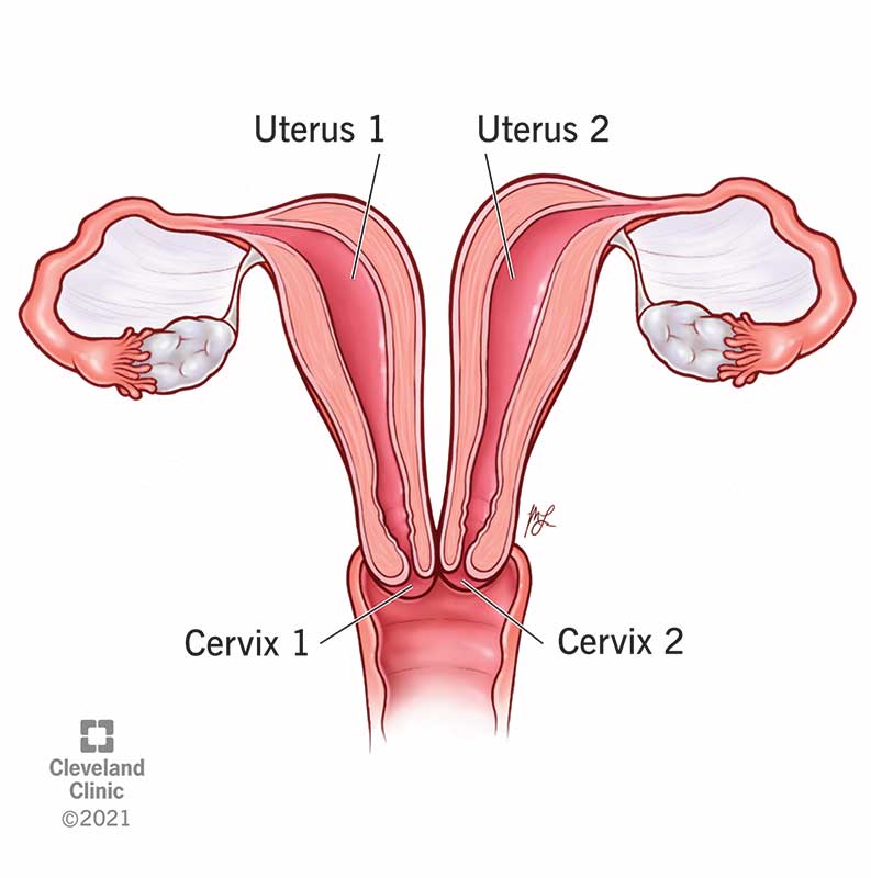 Uterus didelphys: Illustration of a double uterus with the cervix and uterus labeled.