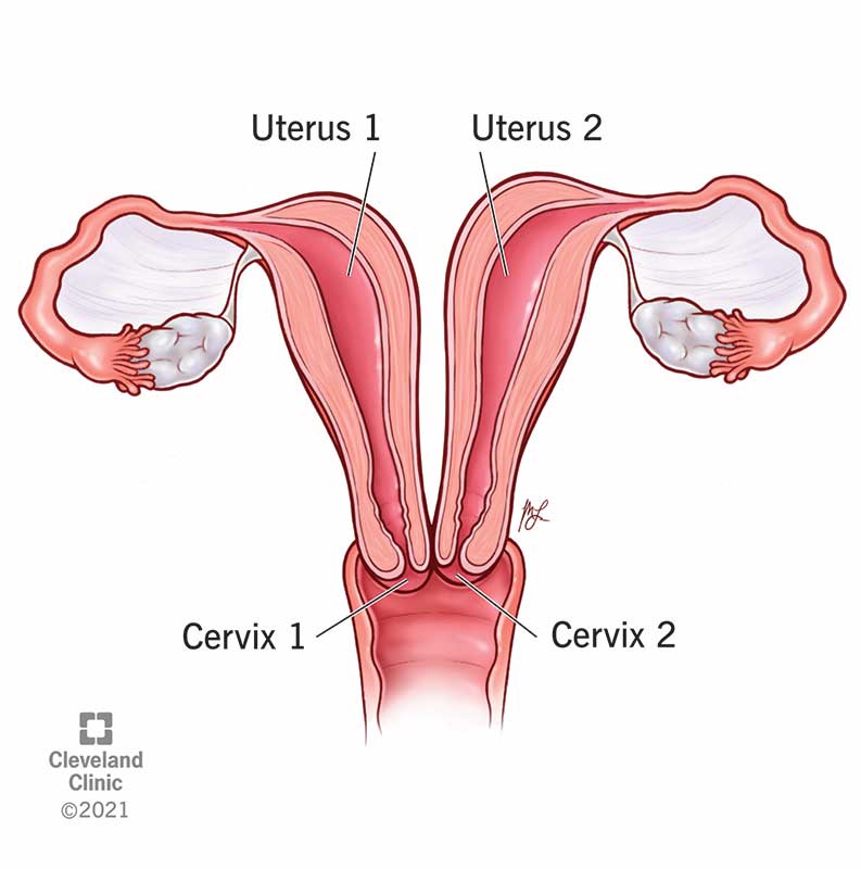 Uterus Didelphys Causes Symptoms Diagnosis Treatment