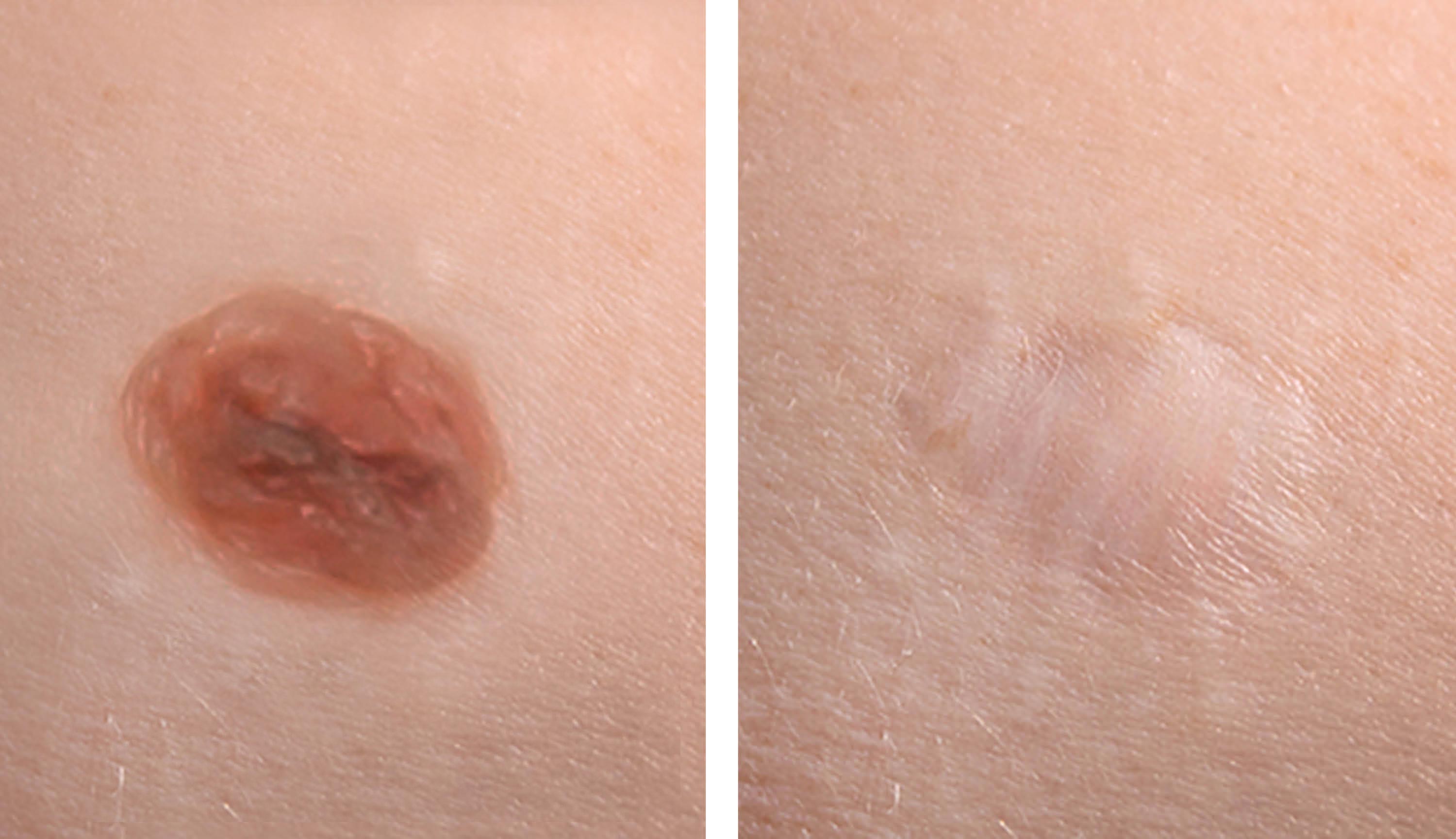 Mole removal before and after: the skin has healed completely.