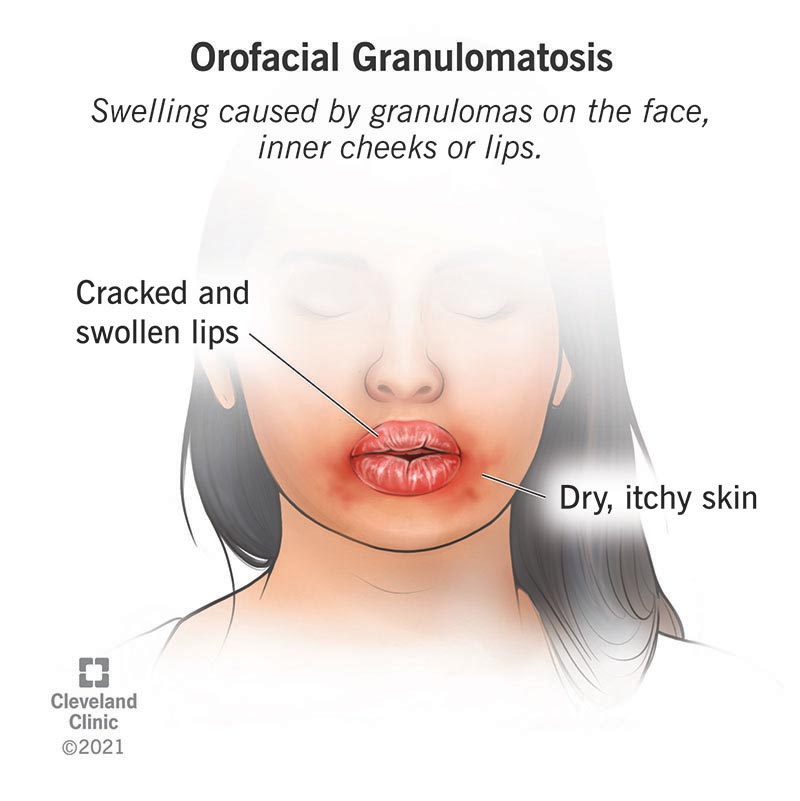 Lips that are dry, cracked and swollen due to orofacial granulomatosis.