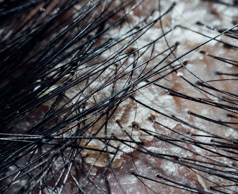 Flaking skin on a person’s head associated with dry scalp.