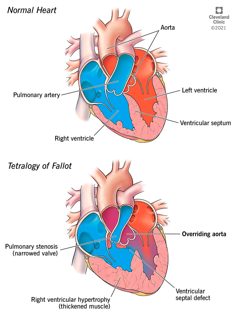 Overriding aorta is located above the ventricular septal defect.