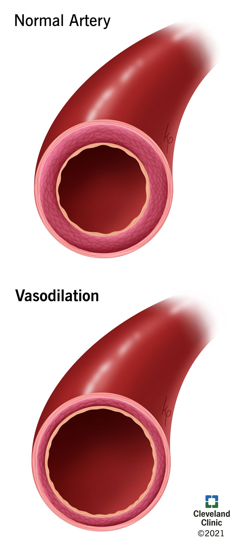 Vasodilation causes an affected blood vessel to widen, allowing more blood to flow through.