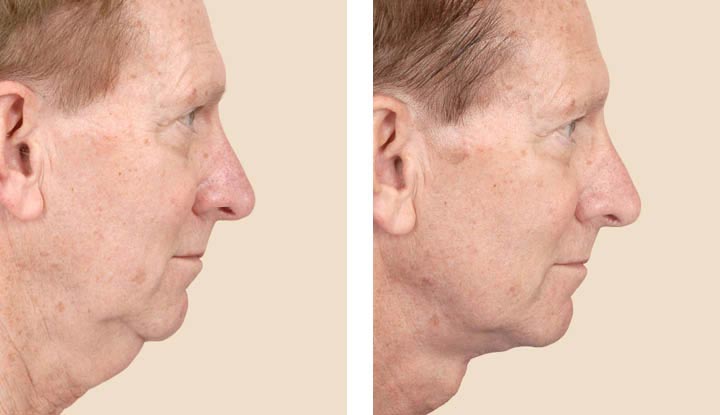 A person before and after neck lift surgery with changes to the skin on their neck.