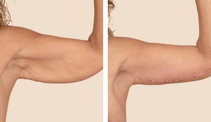 A person’s upper arm before and after brachioplasty surgery.