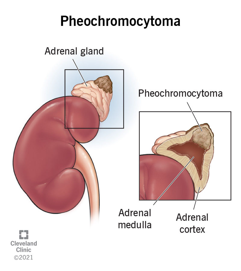 Pheochromocytoma in your adrenal gland.