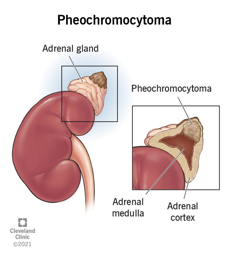 pheochromocytoma-causes-symptoms-treatment