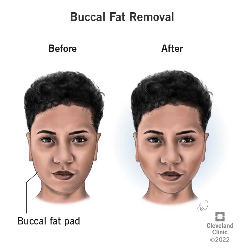 A Black female before and after buccal fat pad removal.