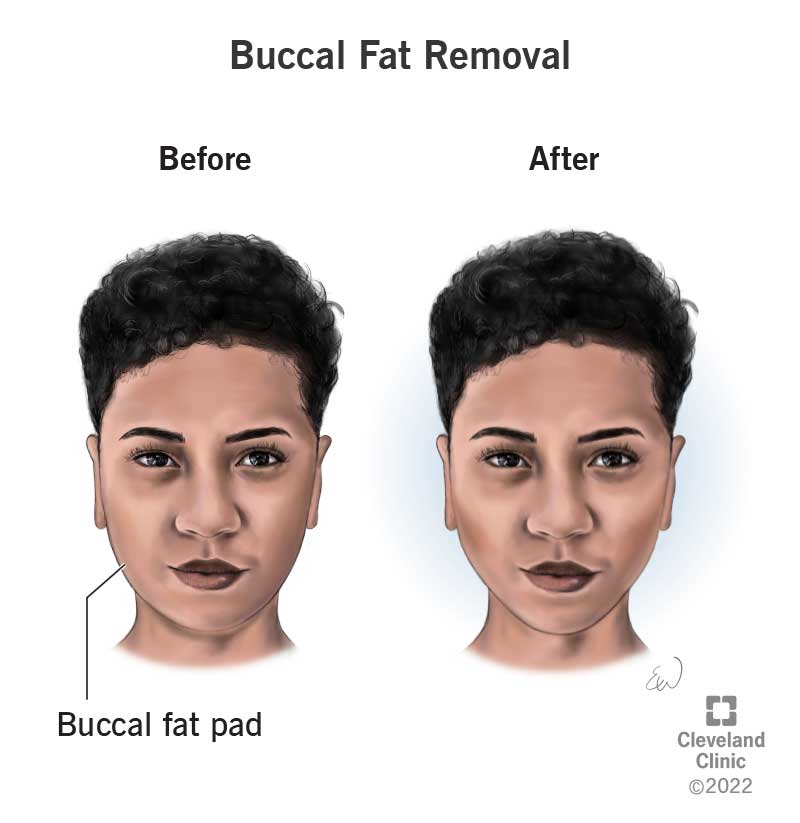 Buccal Fat Removal What It Is Recovery And Before And After | Free Hot ...