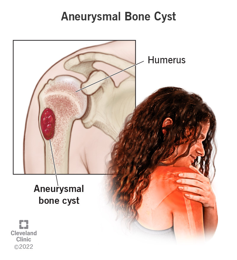 Illustration of an aneurysmal bone cyst in a humerus (upper arm bone)