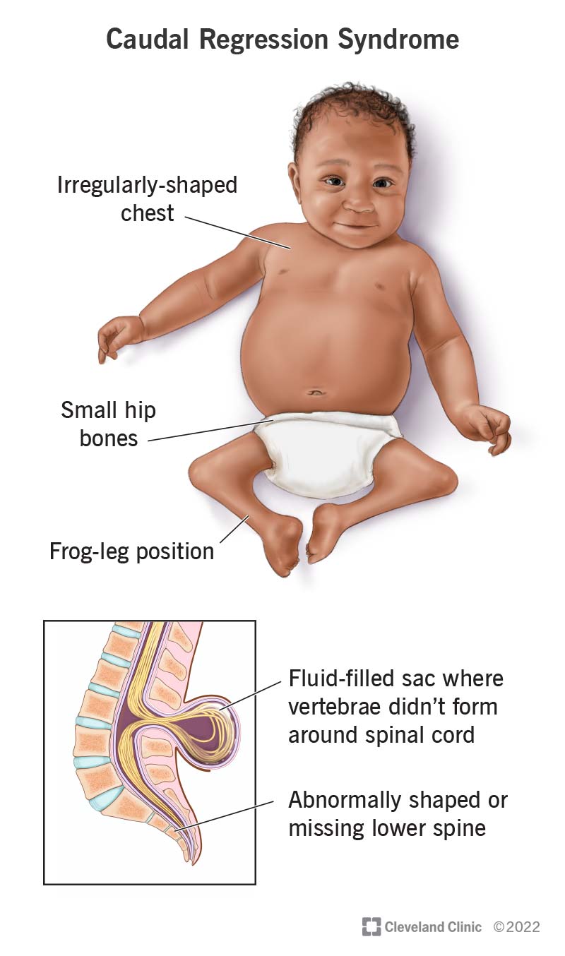 An illustration of a baby with caudal regression syndrome and a magnified image of their spine.