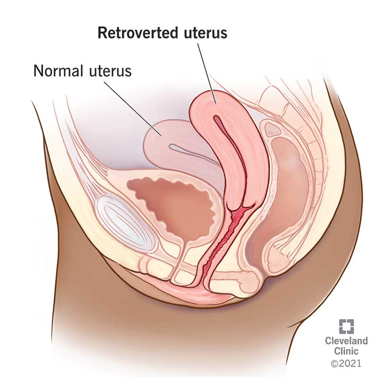 Female reproductive anatomy showing tilted uterus.
