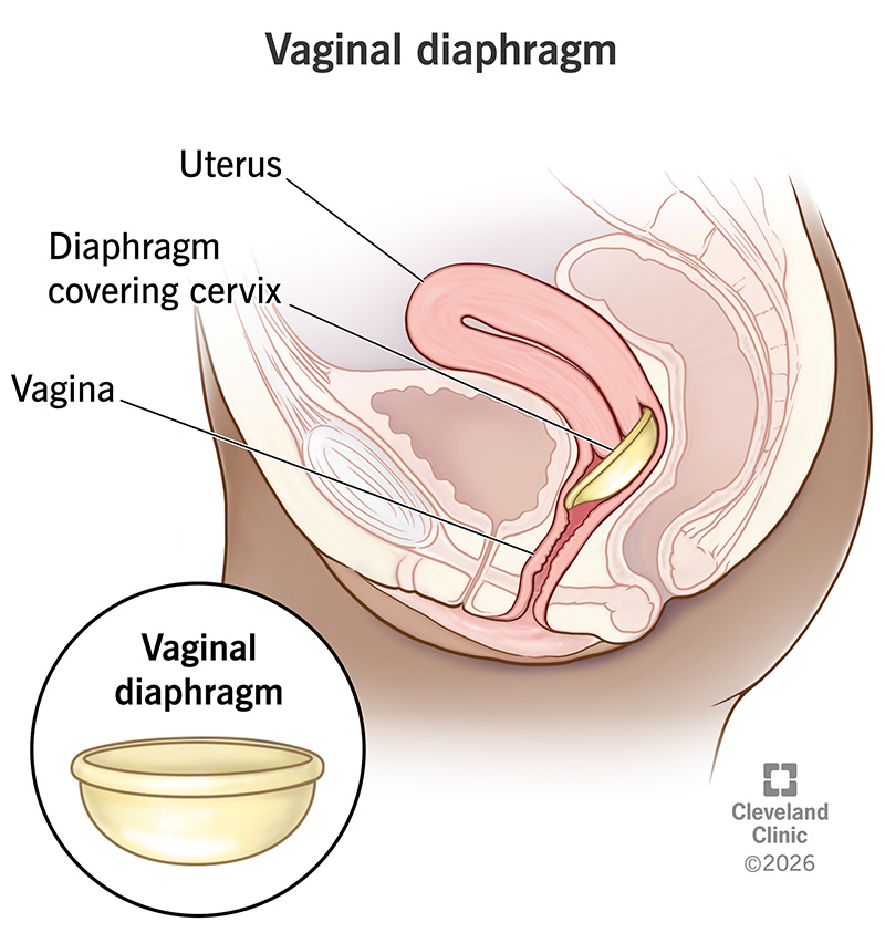 Vaginal diaphragm over a cervix for birth control