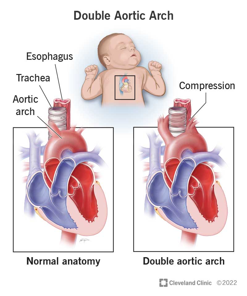 What Is A Double Aortic Arch?