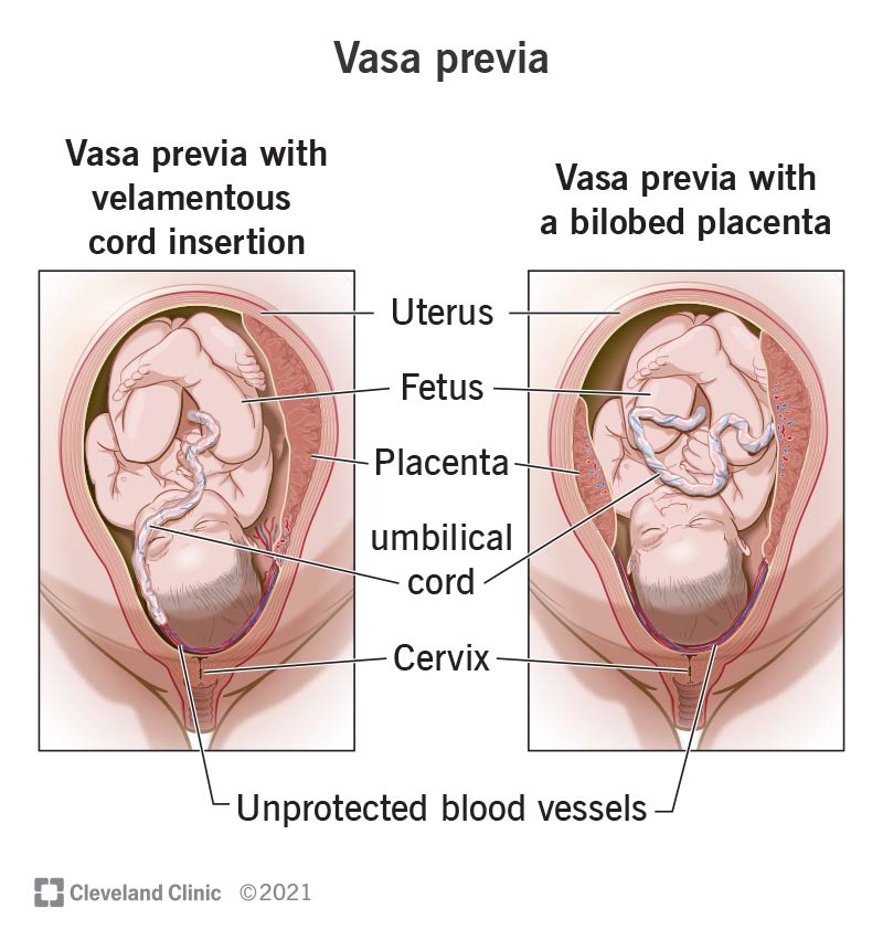 Vasa previa with velamentous cord insertion vs vasa previa with a bilobed placenta.