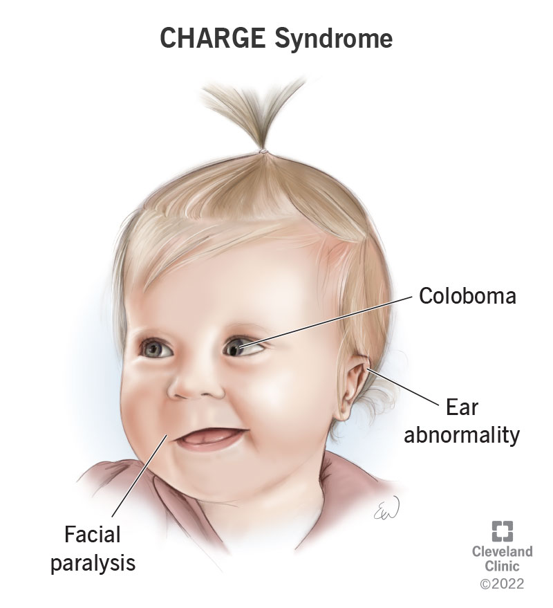 A baby diagnosed with CHARGE syndrome has facial paralysis, a notch in their iris (coloboma) and ears that grow abnormally.