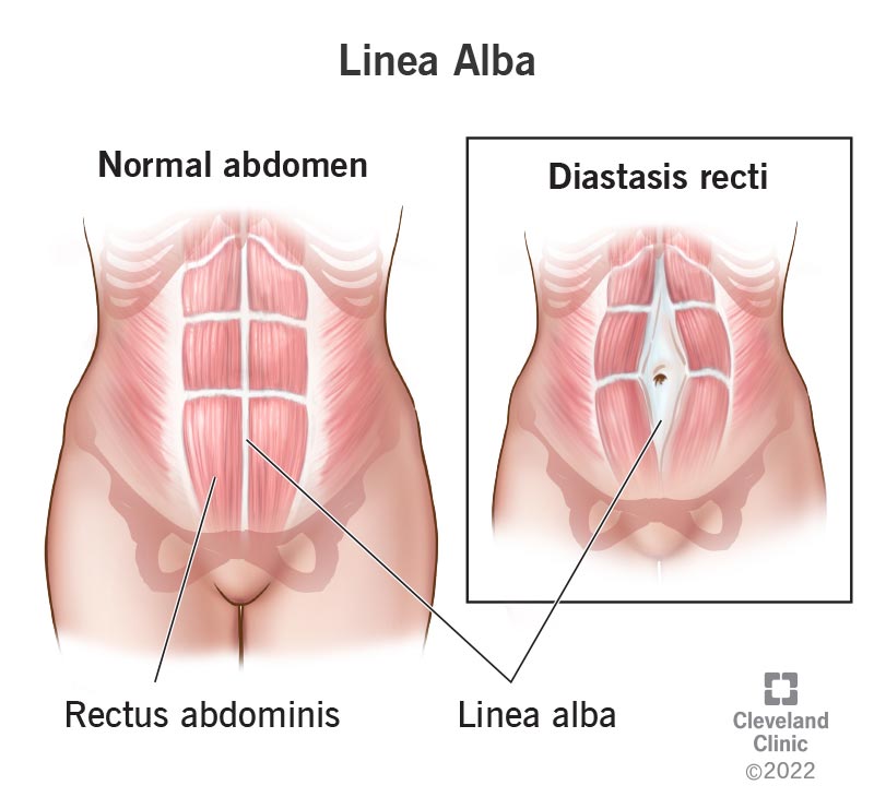 Linea alba on a typical abdomen compared to a linea alba on an abdomen with diastasis recti.