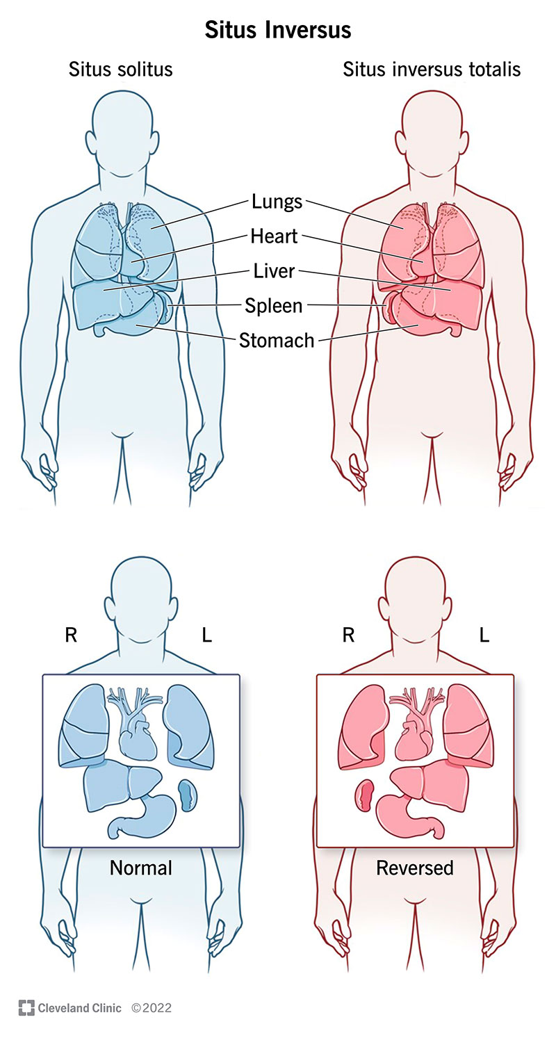 Situs inversus means the organs in your chest and abdomen are in the reverse position of normal human anatomy.