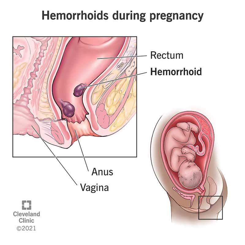 The colon, rectum and anus of a pregnant person with hemorrhoids inside the rectum.