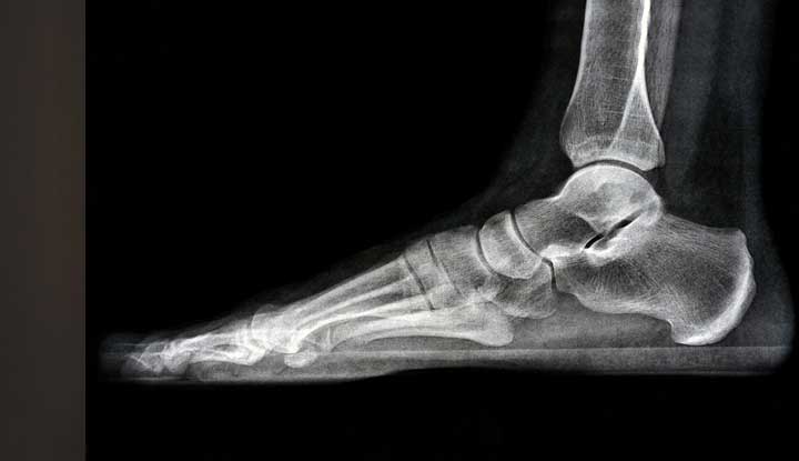 normal ankle xray ap