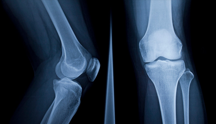A knee X-ray is an imaging test that creates a black-and-white photo of the soft tissues & bones in & around your knee joint.