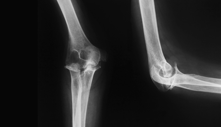 normal elbox x ray; anatomy of a normal elbow xray