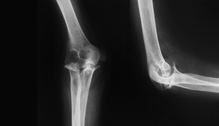 olecranon bursitis xray