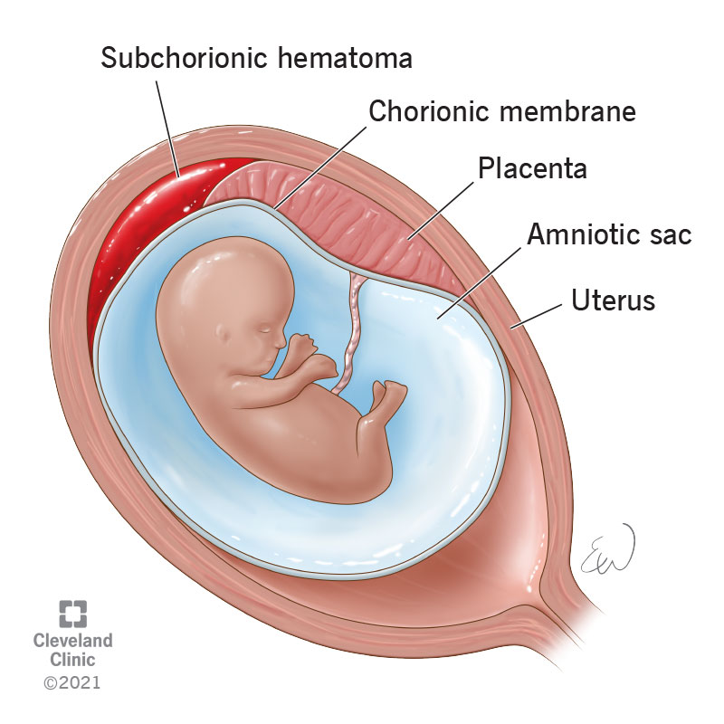 Bleeding subchorionic hematoma in the uterus.