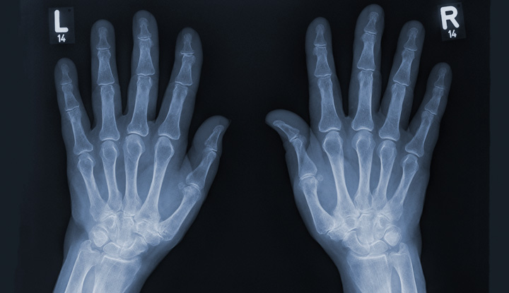 broken hand bones xray