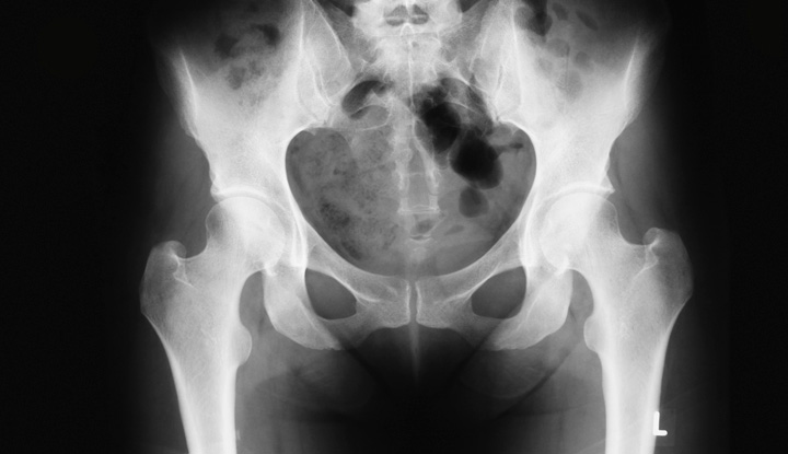 Pelvic X-ray image reveals normal pelvis.